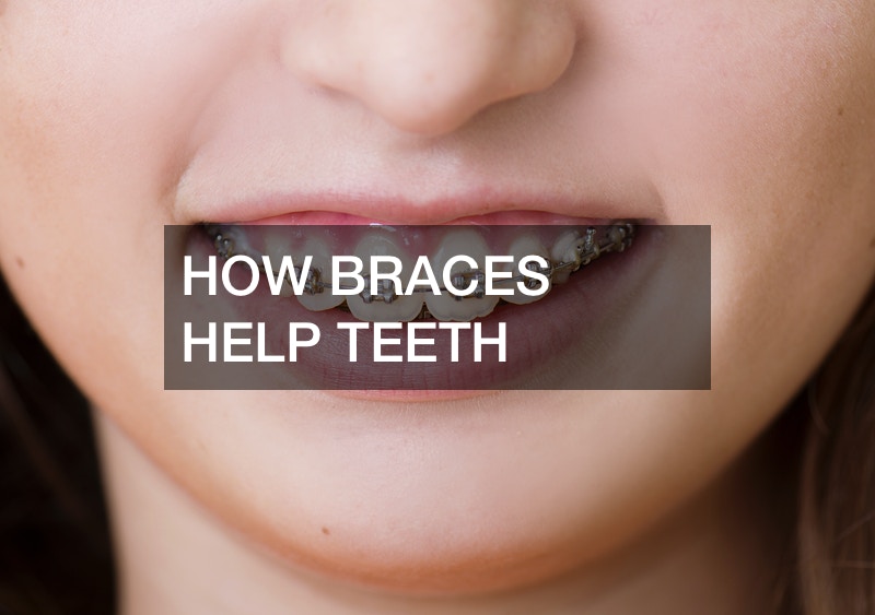 How Braces Help Teeth